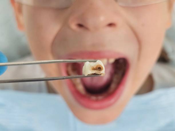 Best Emergency Root Canal Treatment in Mount Clemens, MI